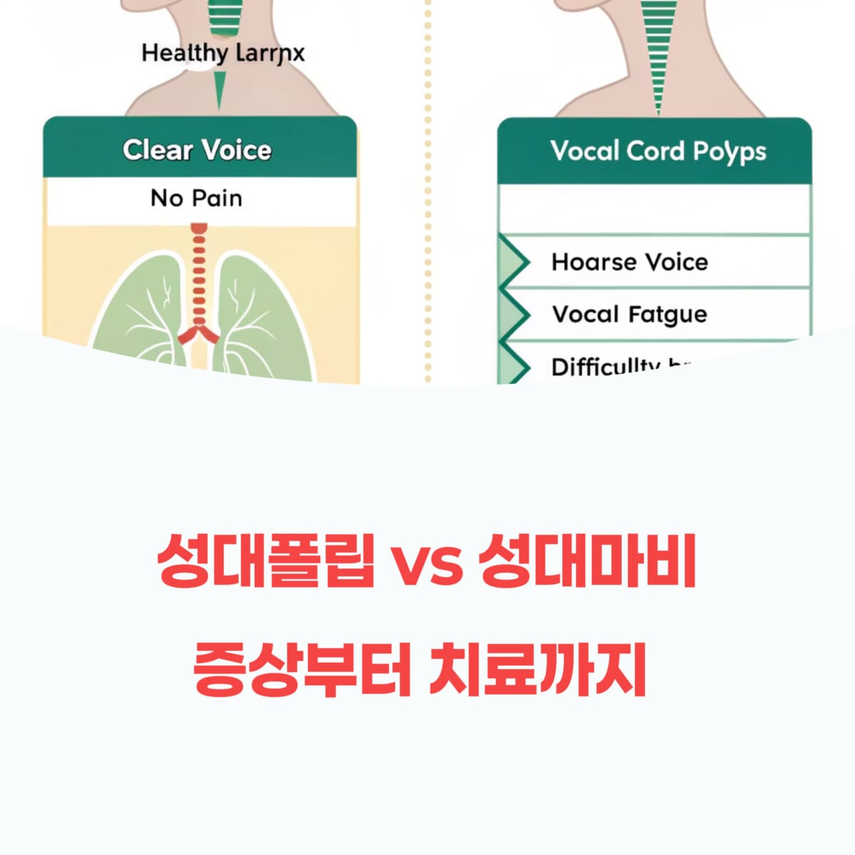 성대폴립 vs 성대마비: 증상부터 치료까지 완전 비교 가이드